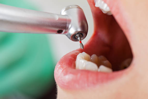 Best Emergency Treatment for Oral Infections in Decordova, TX